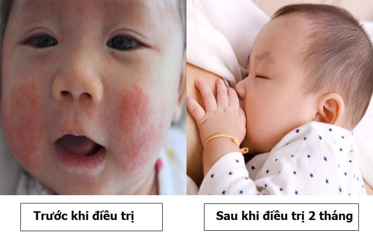Hình ảnh trước và sau khi điều trị chàm sữa