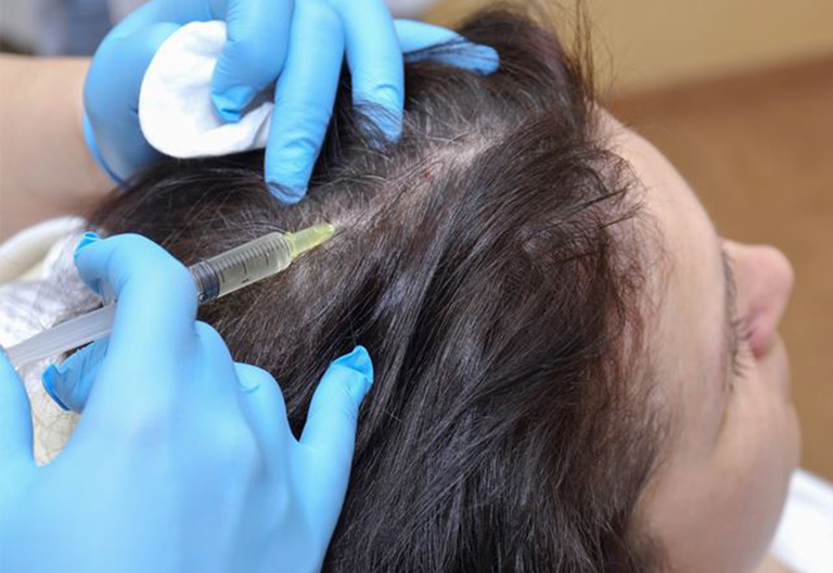 Tiêm steriod vào da đầu ở vùng bị rụng tóc giúp ngăn chặn quá trình đào thải của hệ miễn dịch 