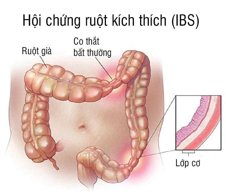 Hội chứng ruột kích thích gây đau bụng đi ngoài sau khi ăn