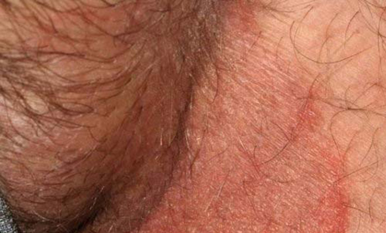 triệu chứng nấm da vùng kín