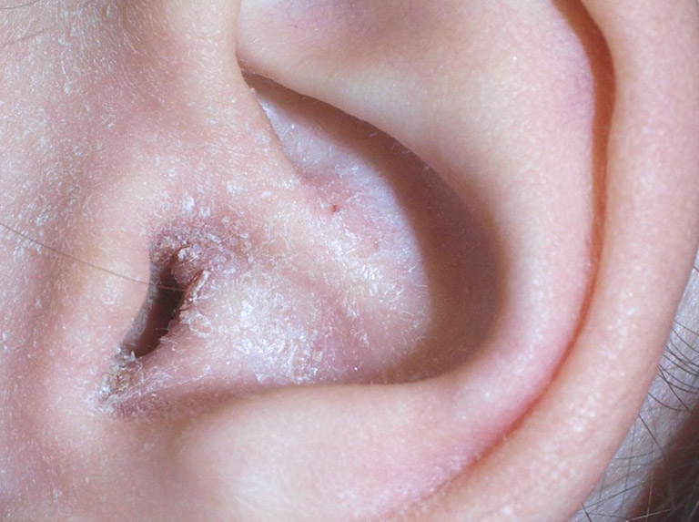 Nổi mụn nước ở vành tai – Nguyên nhân và cách điều trị