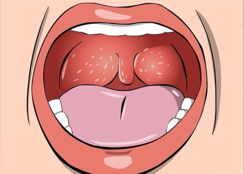 Nổi mụn trắng trong cổ họng có thể là dấu hiệu cảnh báo nhiều bệnh nguy hiểm