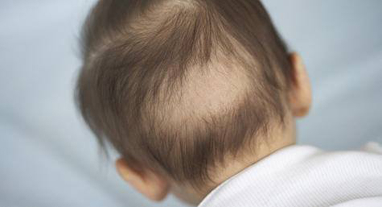 Rụng tóc là tình trạng thường gặp ở hầu hết các trẻ sơ sinh ở 6 tháng đầu đời