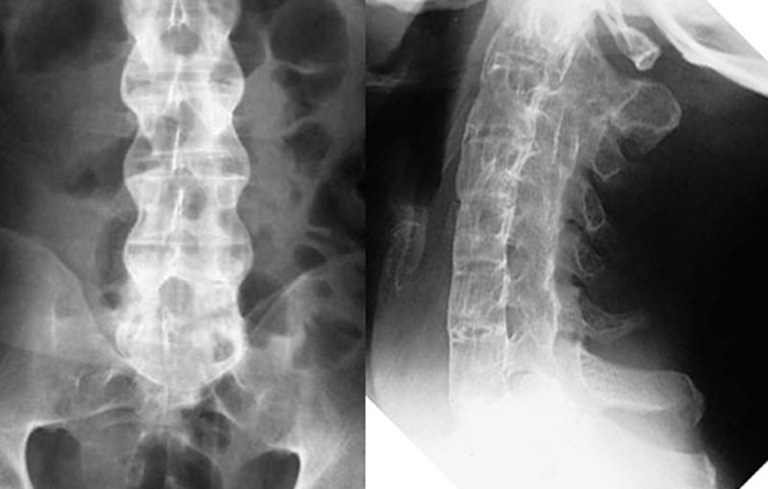 Thoái hóa cột sống thắt lưng – Nguyên nhân, dấu hiệu và điều trị