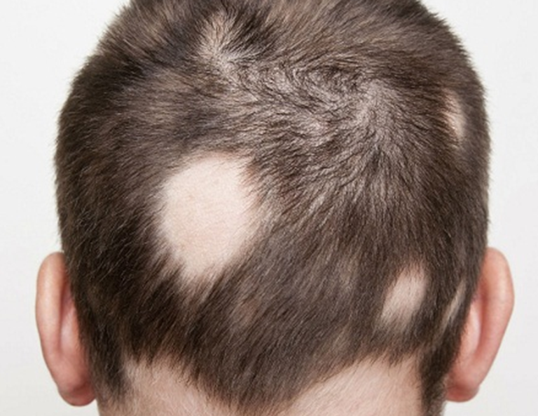 tóc rụng từng mảng là bệnh gì 