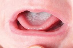 trẻ bị mảng trắng trong miệng