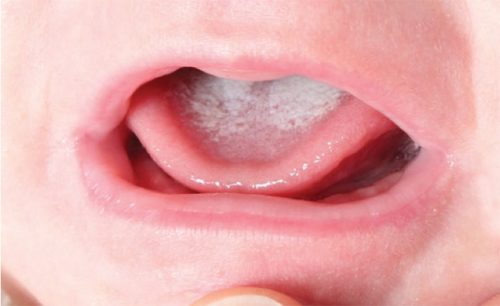 trẻ bị mảng trắng trong miệng