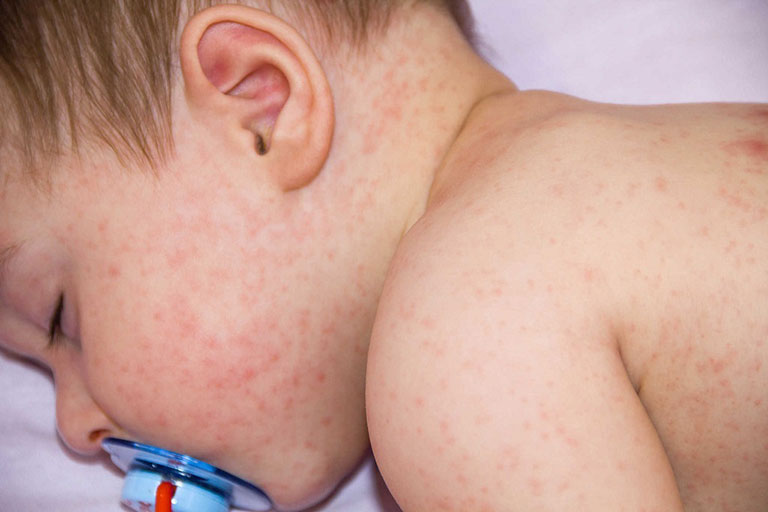 Trẻ bị phát ban sau khi sốt có nguy hiểm không?