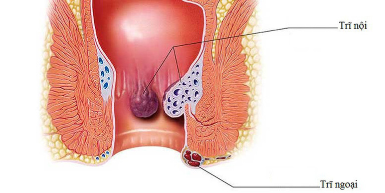 Trĩ nội nằm trong ống hậu môn, trĩ ngoại thì nằm ở ngoài
