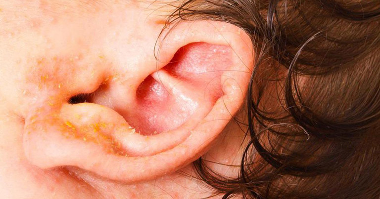 Vành tai bị ngứa chảy nước vàng – Nguyên nhân và cách điều trị