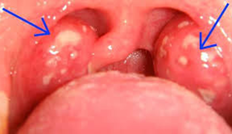 Viêm amidan quá phát là tình trạng amidan bị sưng to gây đau rát và vướng víu ở cổ họng