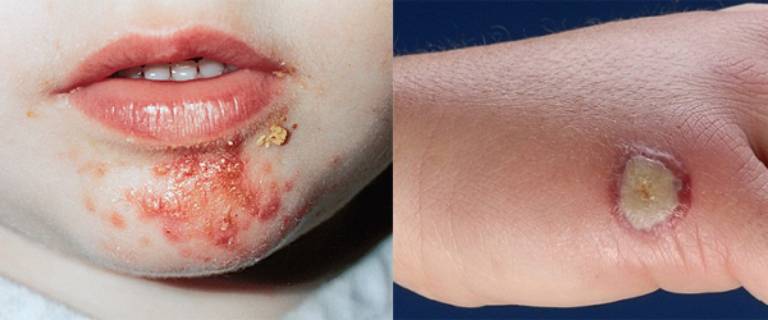 Viêm da liên cầu có nhiều dạng và là bệnh có nguy cơ lây lan cao