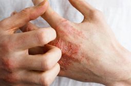 Viêm da tiếp xúc ở tay thường xảy ra khi tay tiếp xúc với chất gây dị ứng hoặc kim loại, chất tẩy rửa, hóa chất