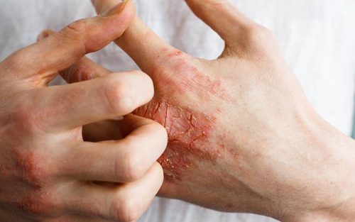 Viêm da tiếp xúc ở tay thường xảy ra khi tay tiếp xúc với chất gây dị ứng hoặc kim loại, chất tẩy rửa, hóa chất