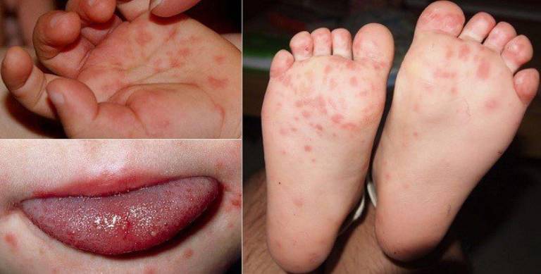Tay chân miệng là bệnh thường gặp ở trẻ em