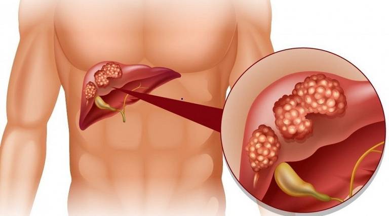 Viêm gan là một trong những nguyên nhân gây đầy bụng khó tiêu thường gặp
