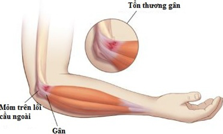 Viêm lồi câu ngoài xương cánh tay: Dấu hiệu, điều trị & phòng ngừa