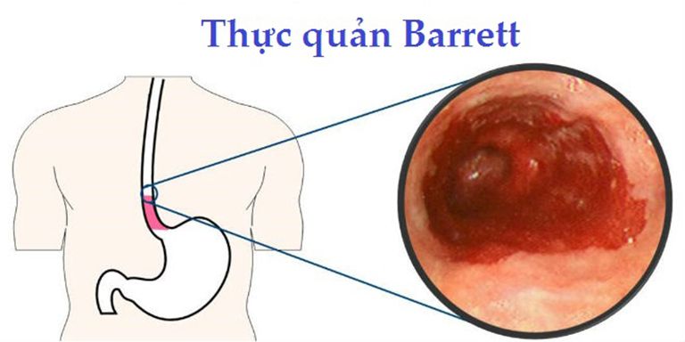 Barrett thực quản là một trong những biến chứng nghiêm trọng của bệnh loét thực quản
