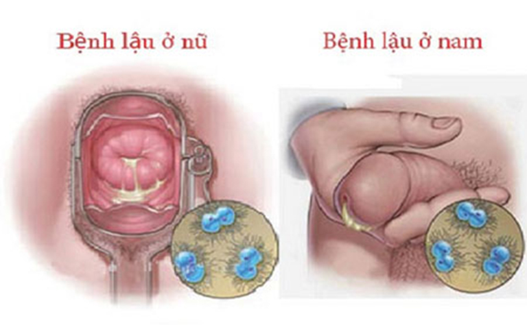 Biểu hiện của bệnh lậu cầu ở nam và nữ