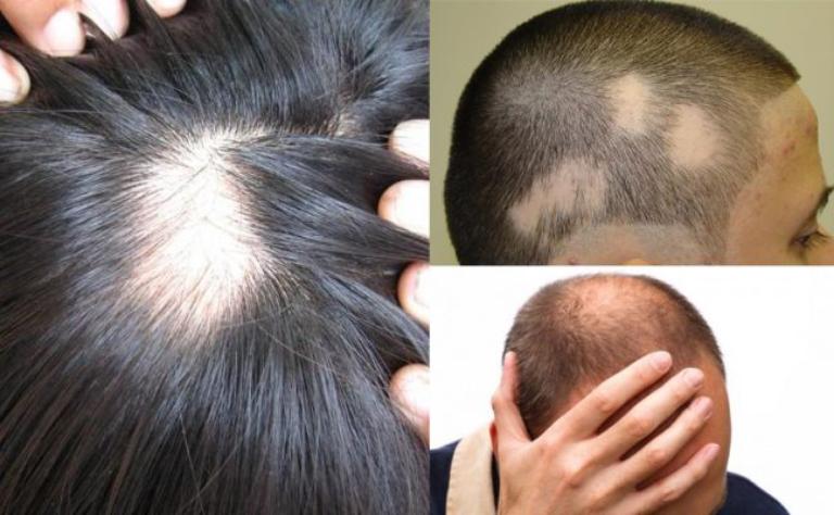 Nếu tình trạng rụng tóc nghiêm trọng, cần thăm khám bác sĩ để được điều trị
