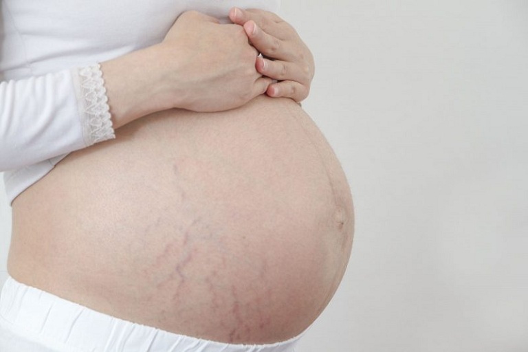 Rạn da khi mang bầu có tự hết không?