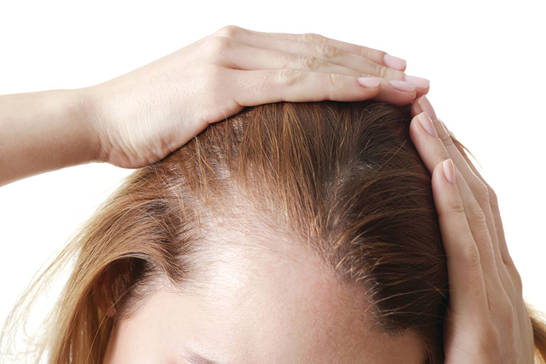 5 cách trị gàu và rụng tóc cực hiệu quả tại nhà