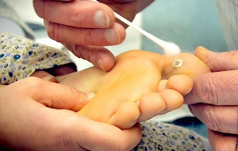 cách chữa mụn cóc ở chân tại nhà