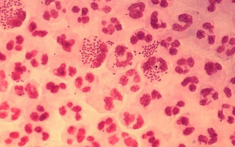 Song cầu khuẩn Neisseria gonorrheae là tác nhân chính gây ra bệnh lậu cầu