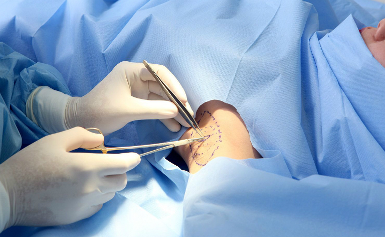 Phẫu thuật cắt bỏ tuyến mồ hôi ở nách là phương pháp điều trị hôi nách cuối cùng.