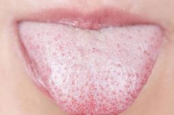 Có nhiều nguyên nhân gây ra hiện tượng lưỡi trắng hôi miệng