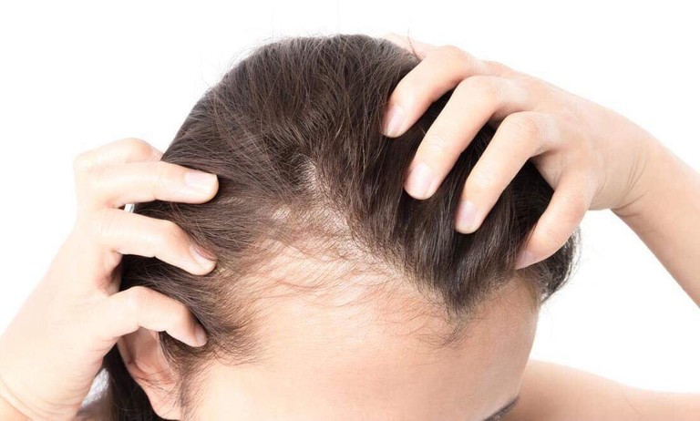 Đừng chà xát quá mạnh vùng mới cấy ghép vì nó có thể khiến các mảnh ghép hoặc nang chân tóc rơi ra trước khi tóc mọc lại bình thường