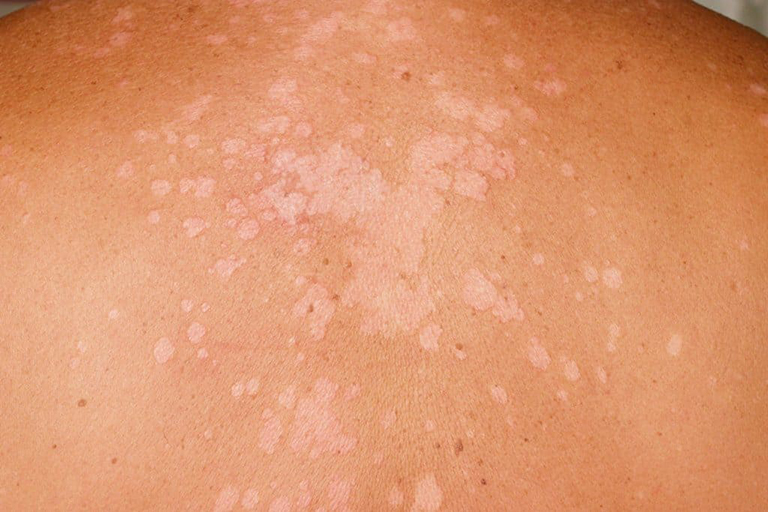 Nấm da không ngứa là bệnh gì? Có nguy hiểm không?