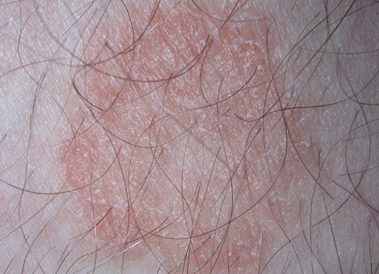 Nấm da không ngứa là bệnh gì? Có nguy hiểm không?