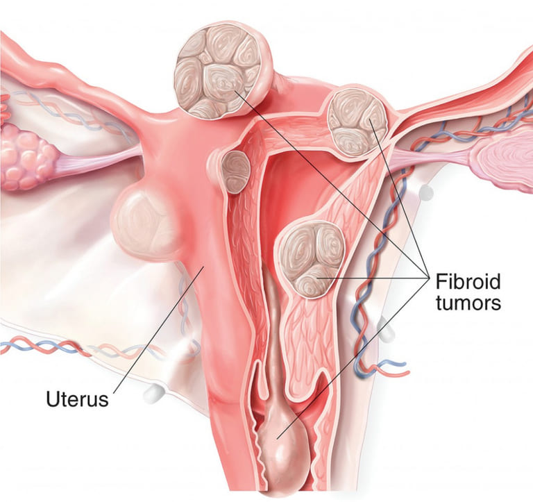 U xơ cổ tử cung là một trong những nguyên nhân gây ra tình trạng kinh nguyệt không đều