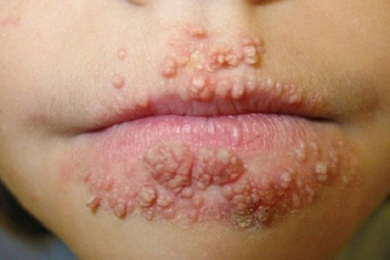 Lậu cầu có khả năng lây nhiễm ra các bộ phận khác trên cơ thể như miệng