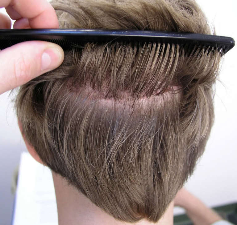 Cắt ghép các nang chân lông đơn lẻ ít ảnh hưởng đến độ dày của tóc