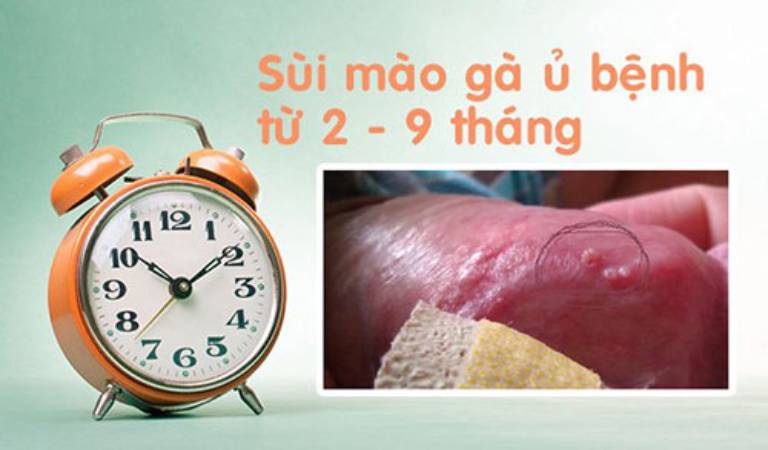 Sùi mào gà có thời gian ủ bệnh từ 2 tuần đến 9 tháng