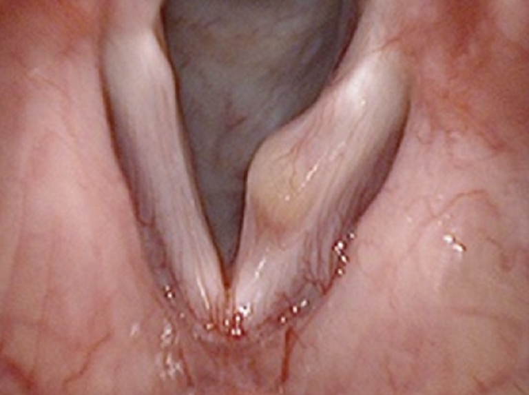 U nang thanh quản là một khối u chứa chất nhầy hoặc mũ nằm ở dây thanh quản