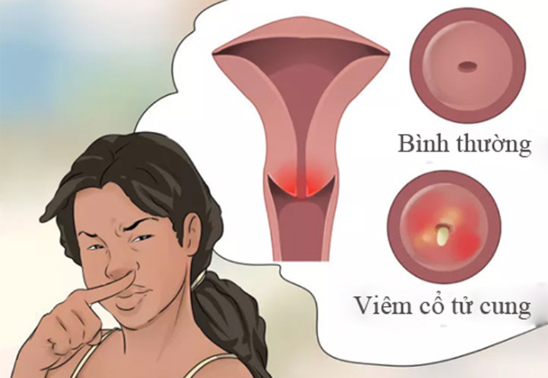 Viêm cổ tử cung là căn bệnh phổ dẫn đến tình trạng khí hư có mùi hôi nhưng không ngứa