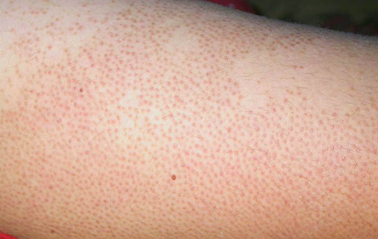 Khi bị viêm lỗ chân lông ở tay, trên da tay xuất hiện các nốt mụn đỏ