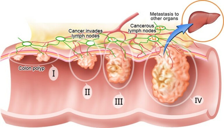 Các giai đoạn ung thư đại tràng