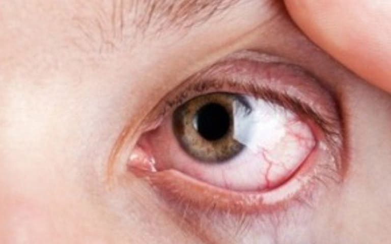 Một trong những dấu hiệu thường gặp nhất khi bệnh tiểu đường chuyển sang biến chứng là đau ở hốc mắt. Không điều trị kịp thời có thể dẫn đến mù lòa