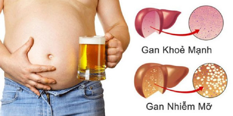 bệnh lý thường gặp do béo phì hay lạm dụng rượu bia