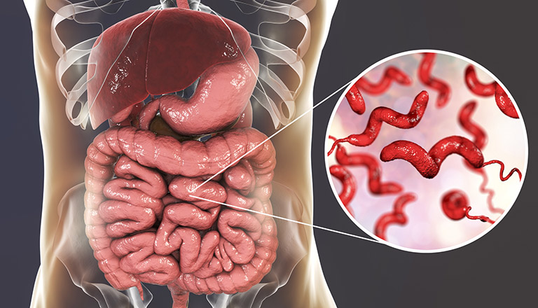 Viêm dạ dày ruột là gì? Mức độ nguy hiểm và cách chữa