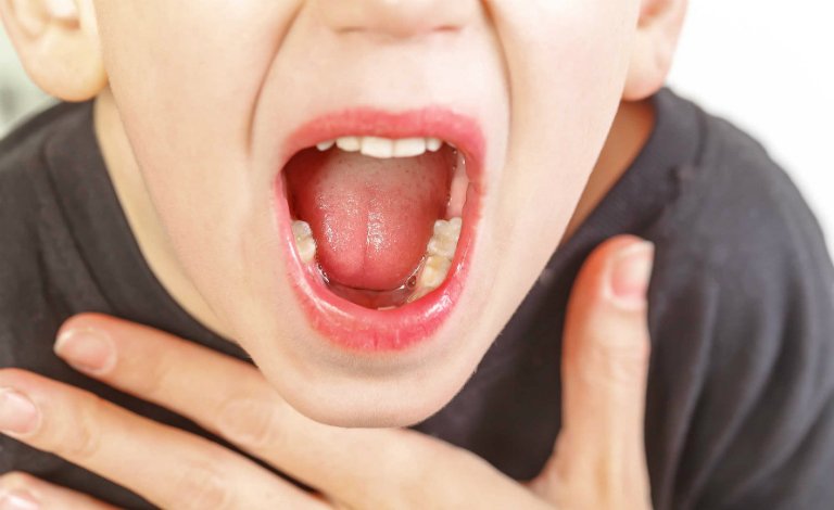 Cổ họng và amidan của bệnh nhân viêm họng đỏ sẽ sưng đau và xung huyết đỏ.