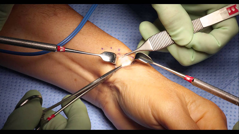 Phẫu thuật mổ hội chứng ống cổ tay tương đối phức tạp