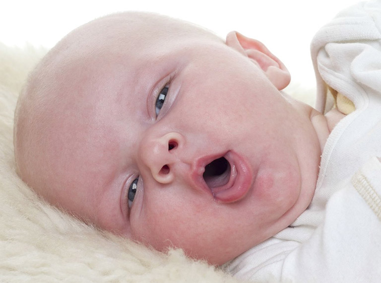trẻ sơ sinh bị nghẹt mũi thở khò khè