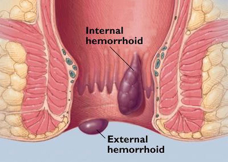 Bệnh trĩ trong tiếng anh “Hemorrhoids” và thông tin cần biết