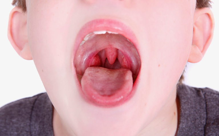 Viêm amidan lưỡi – Nguyên nhân, dấu hiệu và điều trị