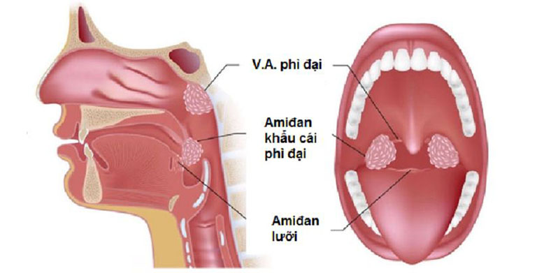 Viêm amidan lưỡi – Nguyên nhân, dấu hiệu và điều trị